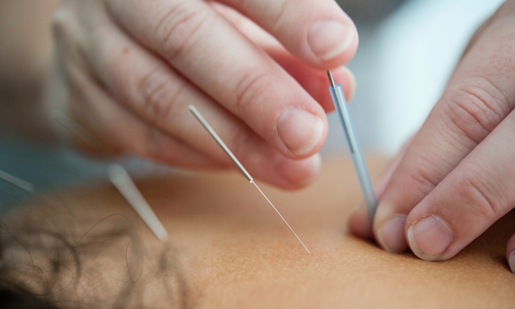 Acupuncture treatment Surrey